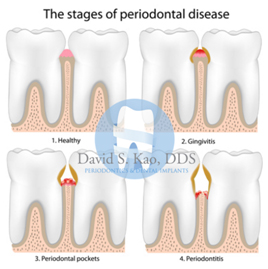 Foods That Help Gum Disease