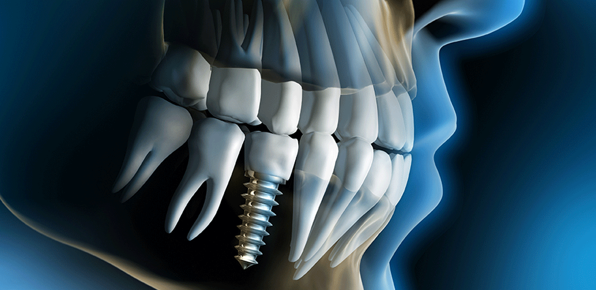 X-ray cutaway graphic of patient's mouth showing dental implant