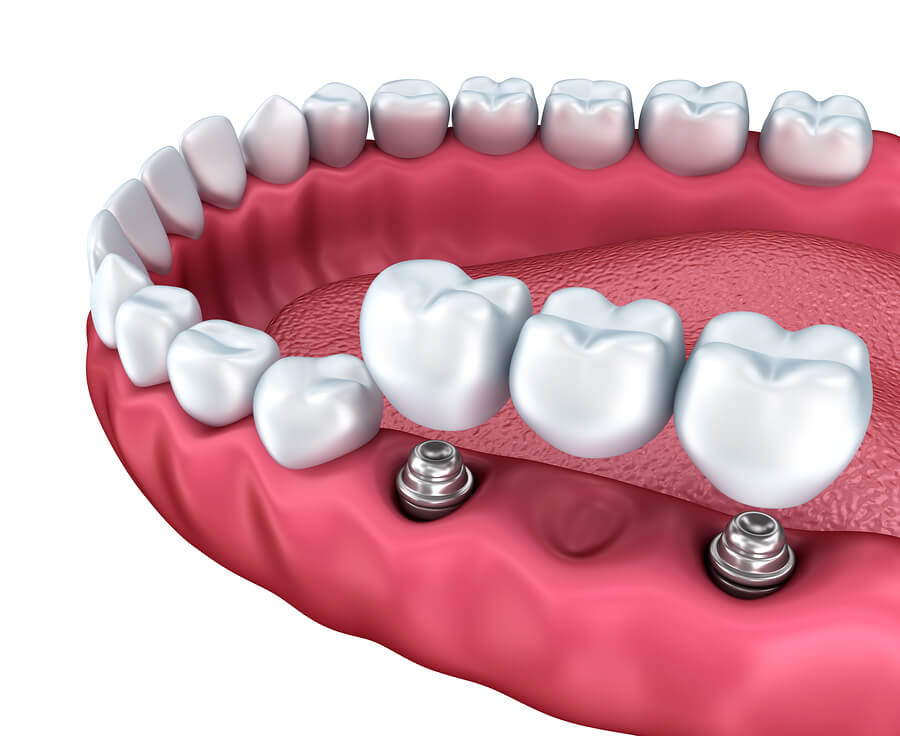 Graphic depicting dental implant bridge installation