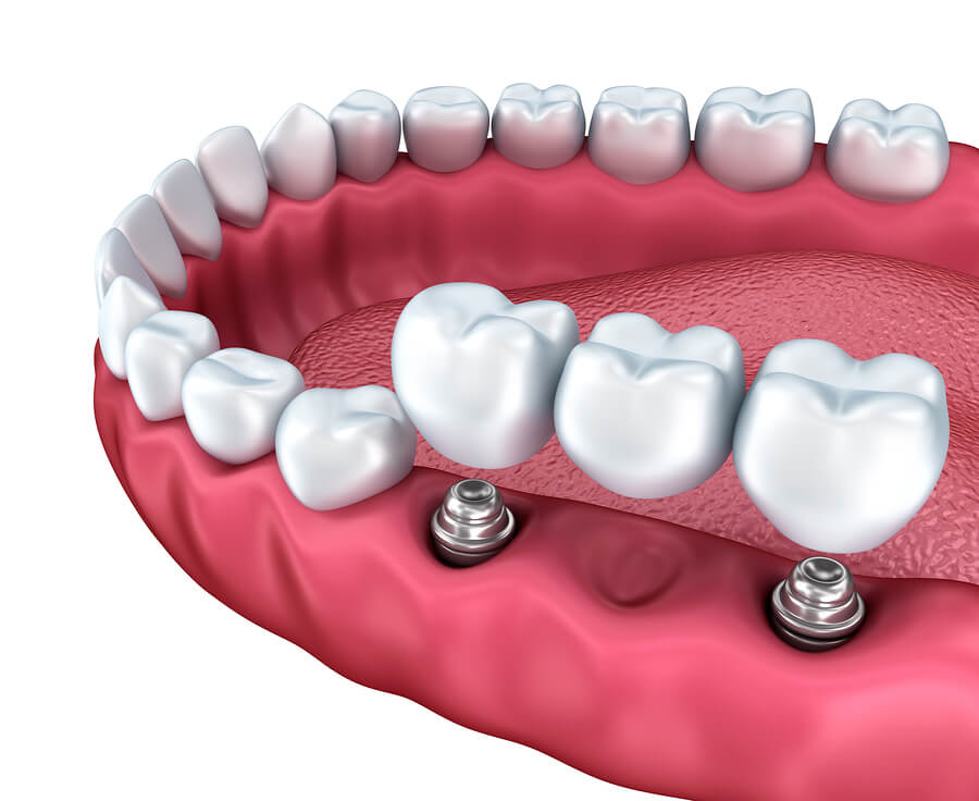 dental implant surgery