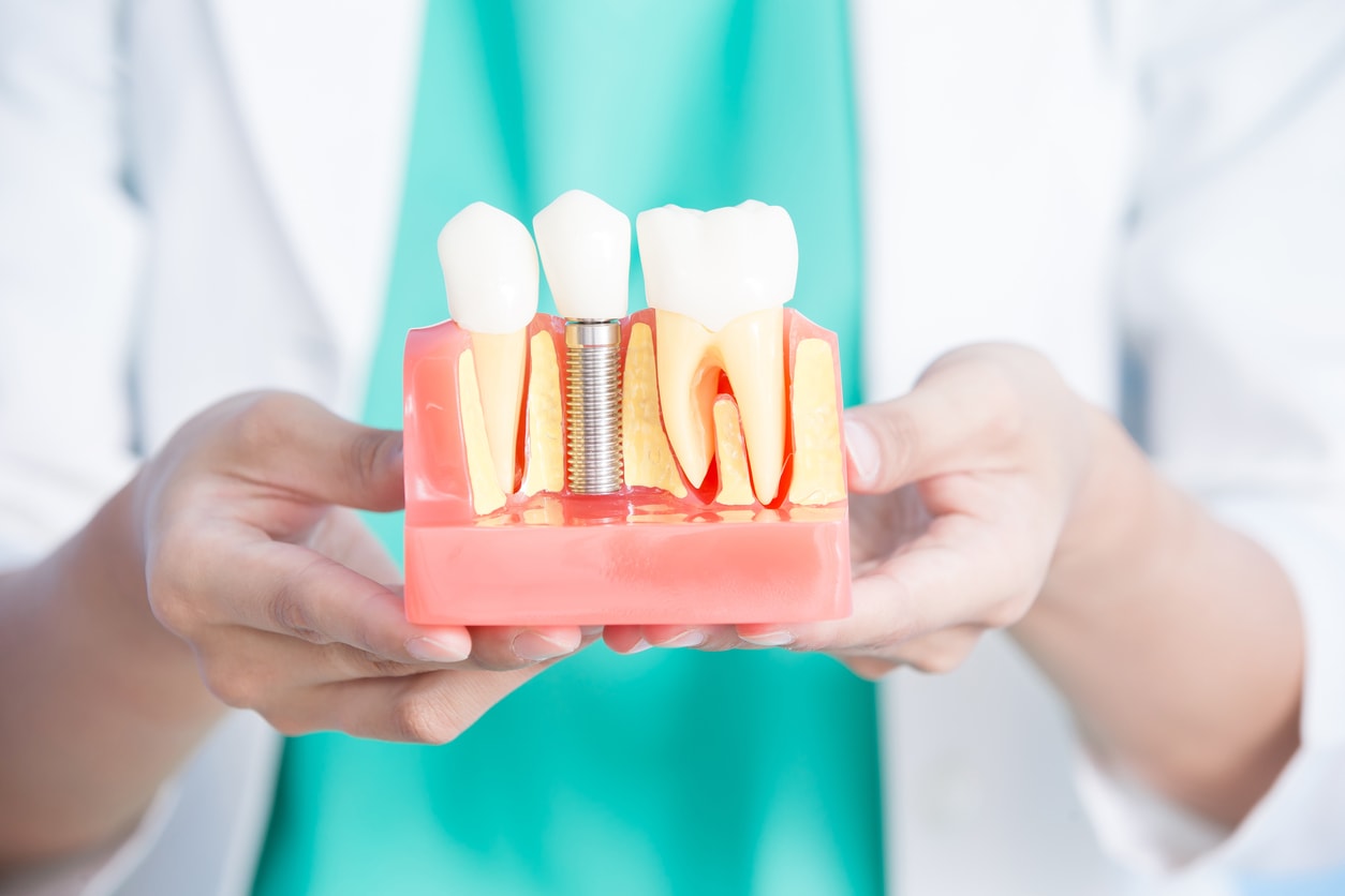 dentist holding cutaway dental implant model