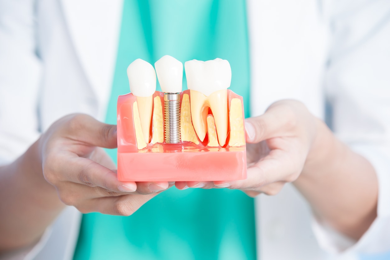 The Dental Implant Process