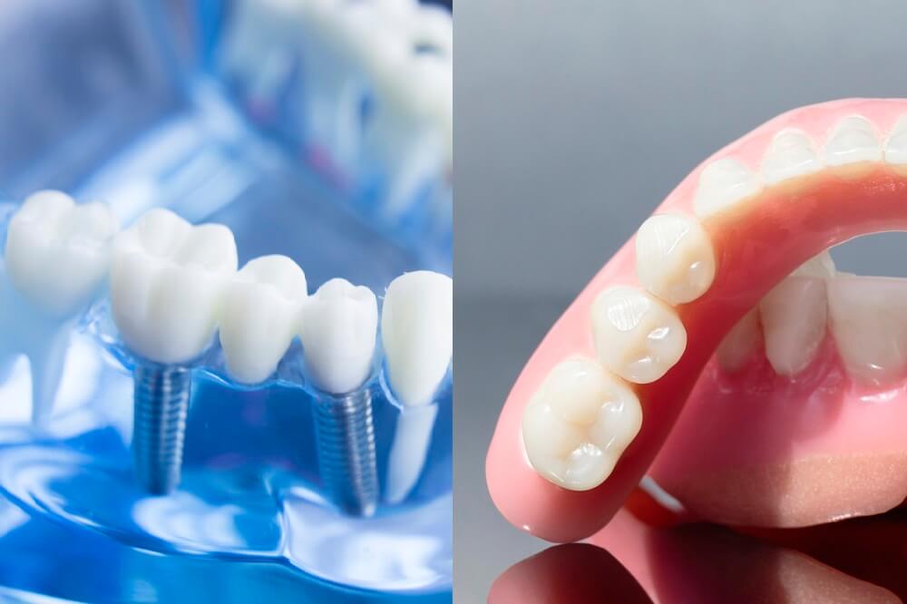 Diagram comparing dental implants on left with dentures on right