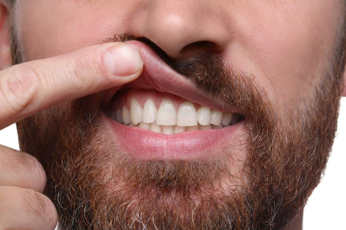 Featured image for Does Pinhole Gum Surgery Last?