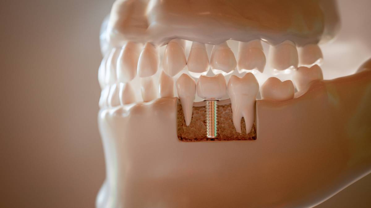 featured image for how long do dental implants last