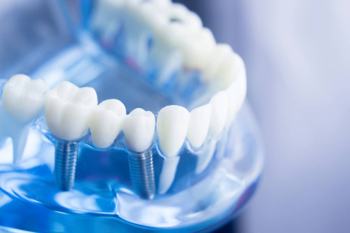 featured image for should i get braces before or after dental implants