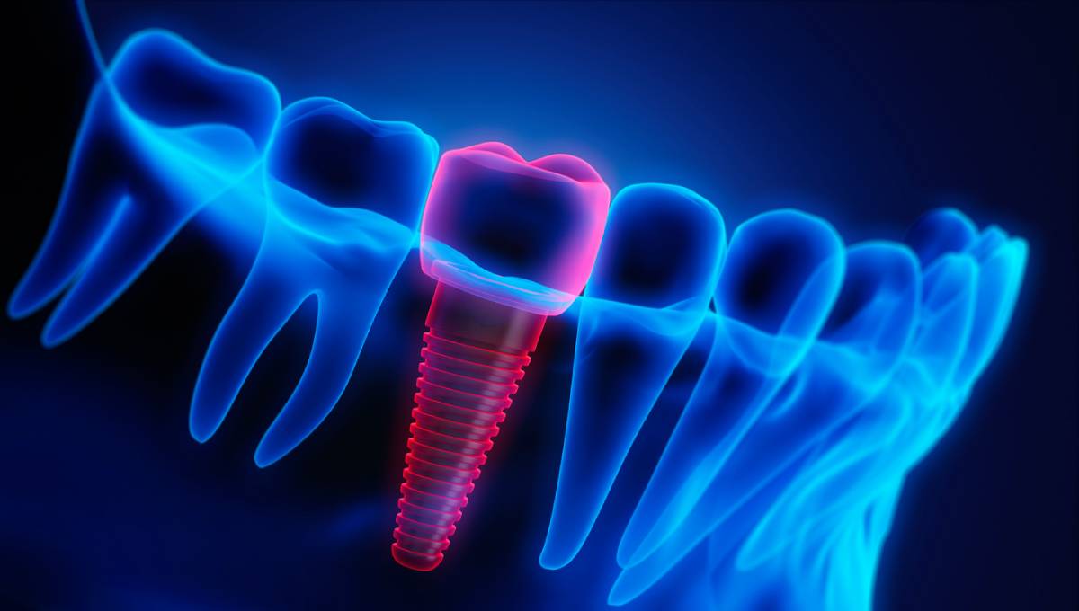 featured image for what are the signs of dental implant failure