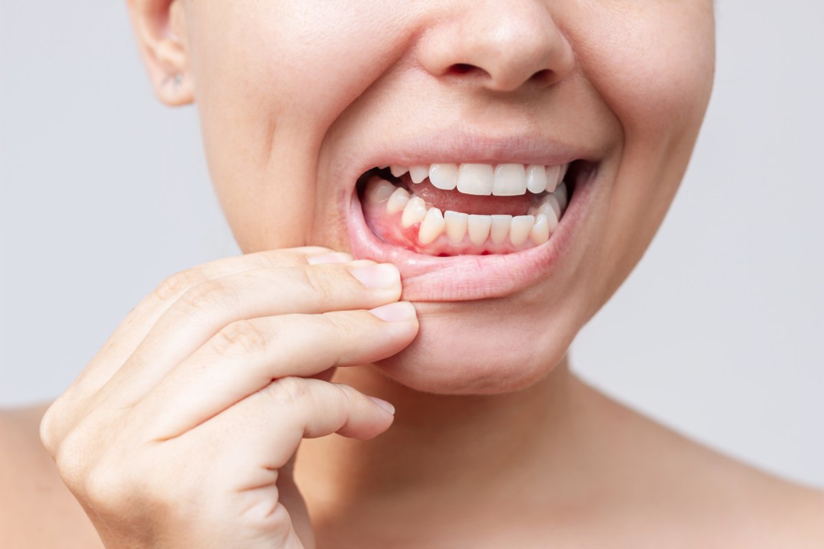 Featured image for Can Gum Disease Be Reversed?